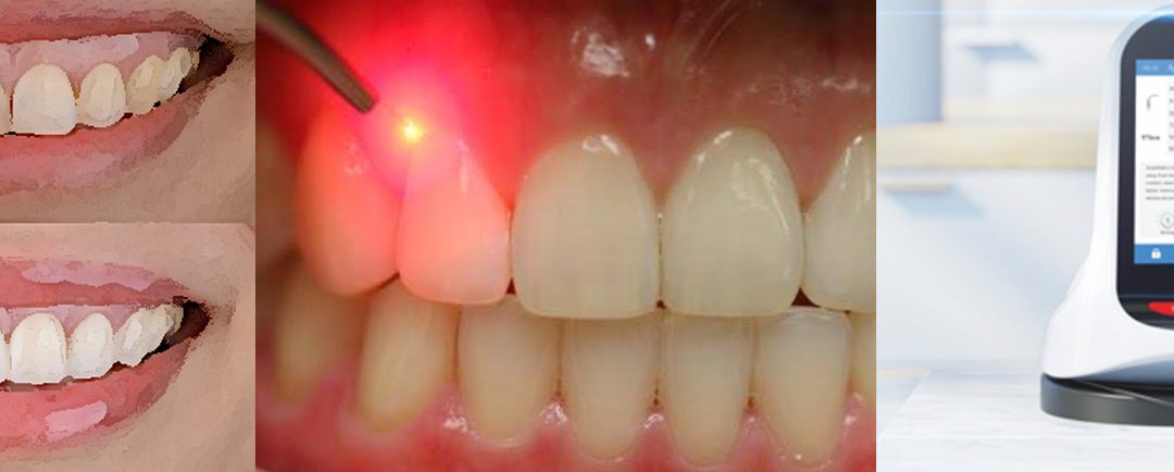 Tratamiento Estético de la Sonrisa Gingival