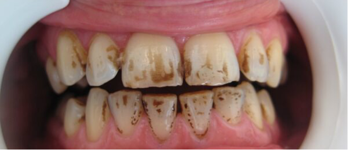 ¿Fumas o Vapeas? así afectan el Tabaco y el Vapeo a tu Sonrisa